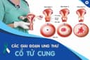 Phát hiện ung thư cổ tử cung từ khi chưa có triệu chứng: Cảnh báo âm thầm nhiều phụ nữ đang bỏ qua