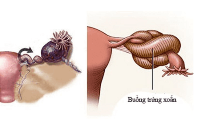 Đau bụng tưởng rối loạn tiêu hóa, cô gái 26 tuổi ngất xỉu, suýt mất buồng trứng: Cảnh báo bệnh nguy hiểm nhiều người chủ quan | Phòng Khám Y Khoa Số 10 Trần Điền