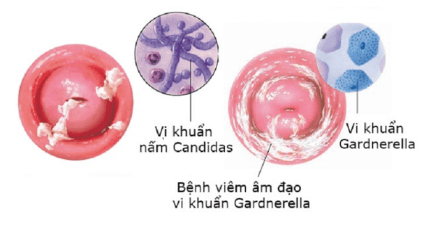 “Cô bé” ngứa, khí hư bốc mùi tanh, đổi màu bất thường: Dấu hiệu cảnh báo bệnh phụ khoa nhiều người bỏ qua